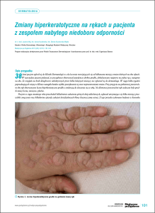 Zmiany hiperkeratotyczne na rękach u pacjenta z zespołem